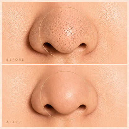 PoreClear™ Facial Extractor Pro — 2